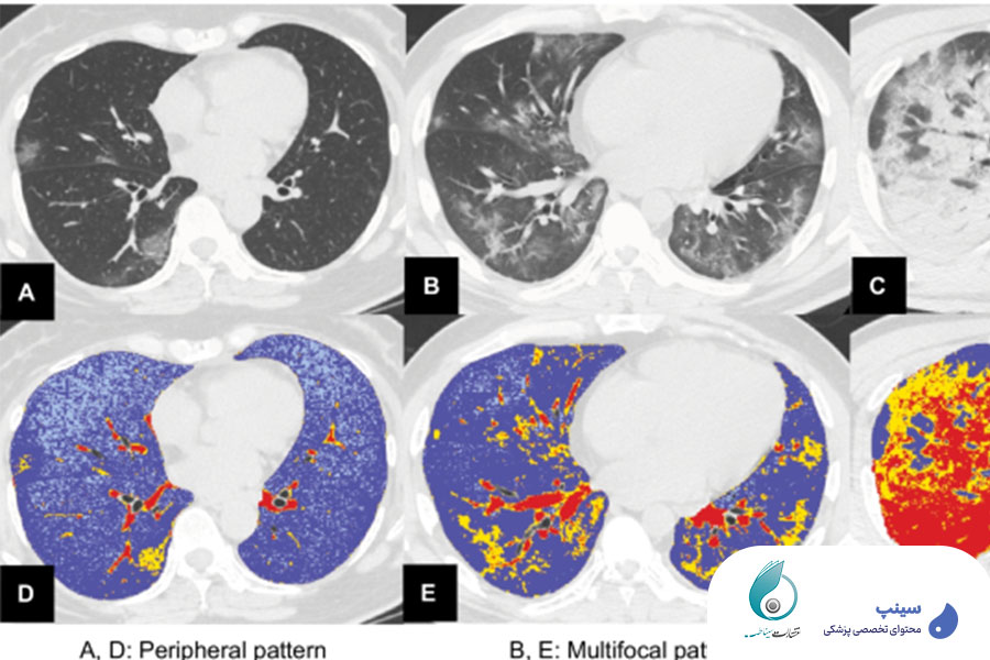 ریپورت نویسی ct ریه