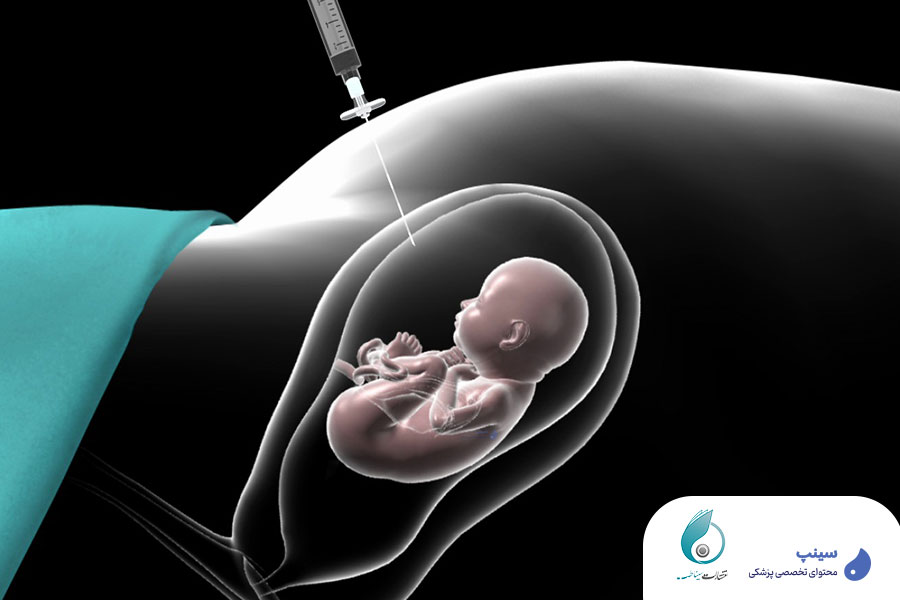 دوره آمنیو سنتز جنین