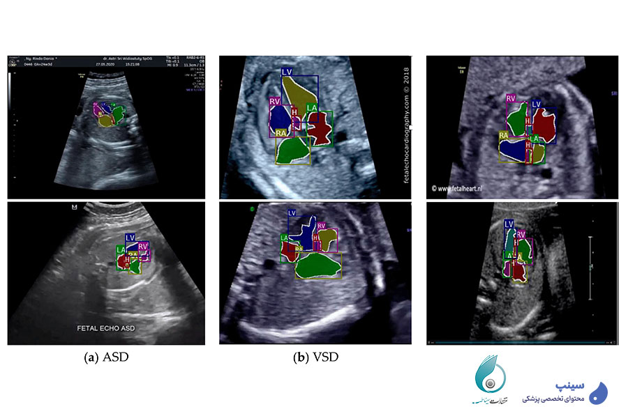 دوره-اکو-قلب-جنین