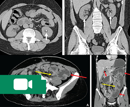 آموزش رادیولوژی پرکتیکال CT -  شکم و لگن