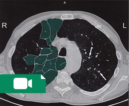 آموزش رادیولوژی پرکتیکال CT  ریه